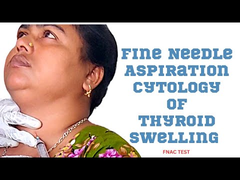Fine Needle Aspiration Cytology Of Thyroid Swelling ।। Thyroid Cancer ।।