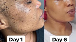 AFFORDABLE WAYS TO GET RID OF SKINTAGS PERMANENTLY | Skincare reviews