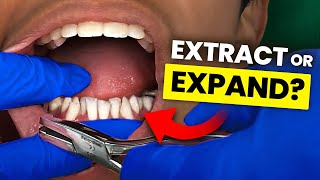 Teeth Crowding… Should you EXPAND or EXTRACT? | Orthodontist Explains