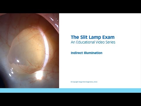 The Slit Lamp Exam – Episode 8, Indirect Illumination
