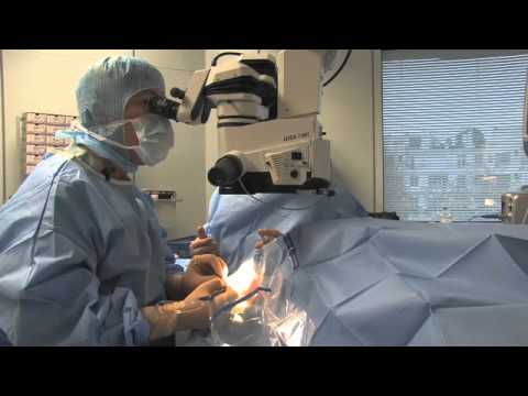 Oeil : Une opération de la cataracte en vidéo