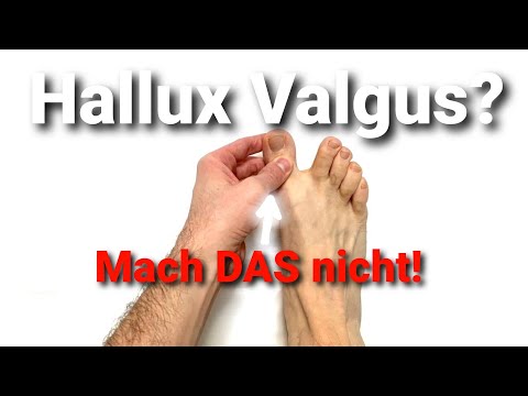 How to train away hallux valgus (avoid surgery) | The 3-step training program from a physiotherapist