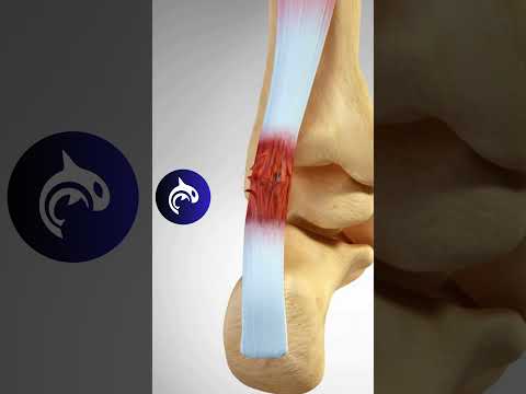 Achilles Tendonitis and Rupture - 3D Animation #achilles #foot #feet