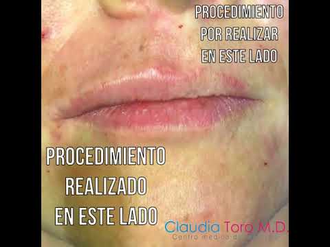 Aumento de labios en Bogotá con la Dra. Claudia Toro