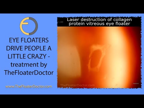 VITREOUS EYE FLOATER  Destruction with a laser because floaters drive people a little crazy