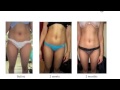 Best Liposuction Surgery in Delhi, India by Dr. Ajaya Kashyap