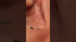 Ear Blackhead #asmrsounds | Dr. Pimple Popper #shorts #pimples #oddlysatisfying