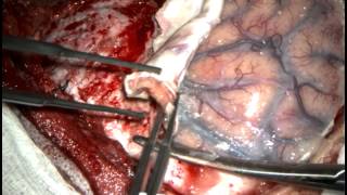 Left pterional craniotomy for thrombectomy and clipping of ruptured left MCA giant aneurysm