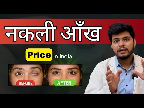 Artificial (Prosthetic) Eye which Moves & Looks like Natural Eye | Complete guide Prosthetic eye