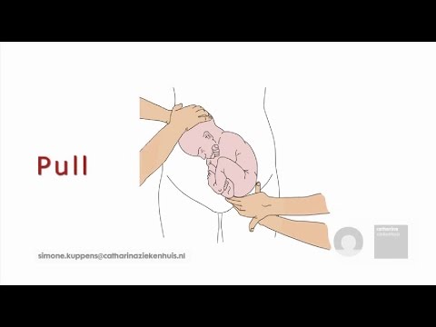 External Cephalic Version (ECV) technique in theory (animation)