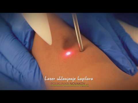 u liječenju hipertenzije lasera