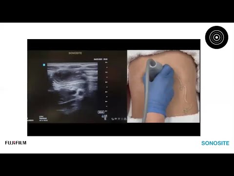 Webinar: Jelly on the Belly: Using POCUS to Improve Pediatric Intussusception Outcomes