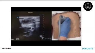 Jelly On the Belly: Using POCUS to Improve Paediatric Intussusception Outcomes