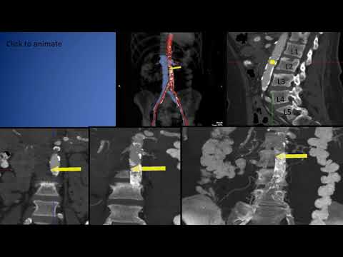 Transcaval TAVI Case
