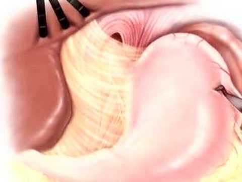 PreOp® Patient Education Hernia Hiatal Laparoscopic Surgery2