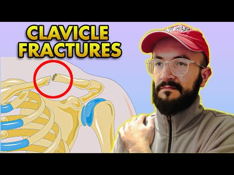 Clavicle Bone Fractures: Anatomy, Classification, Clinical Features and Treatment
