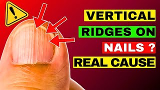 The REAL Causes of VERTICAL RIDGES On Your Nails | HealthQuest