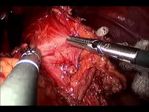 Laparoscopic Heller Myotomy For End Stage Achalasia