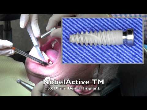 5 Minute Dental Implant - including extraction
