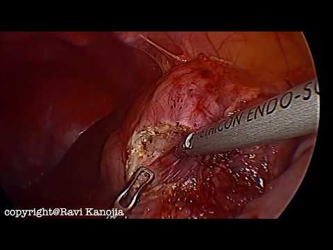 Gastric Duplication Cyst in a 4 year old Boy - Laparoscopic Excision