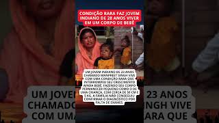 Condição rara faz homem de 28 anos viver em um corpo de bebê
