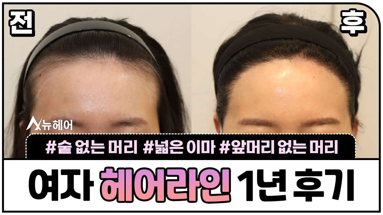 发际线矫正 1年后期 ㅣ1400 毛囊 ~ 1800 毛囊 ㅣ New Hair