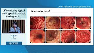 Differentiating Typical and Atypical Endoscopic Findings of IBD 썸네일