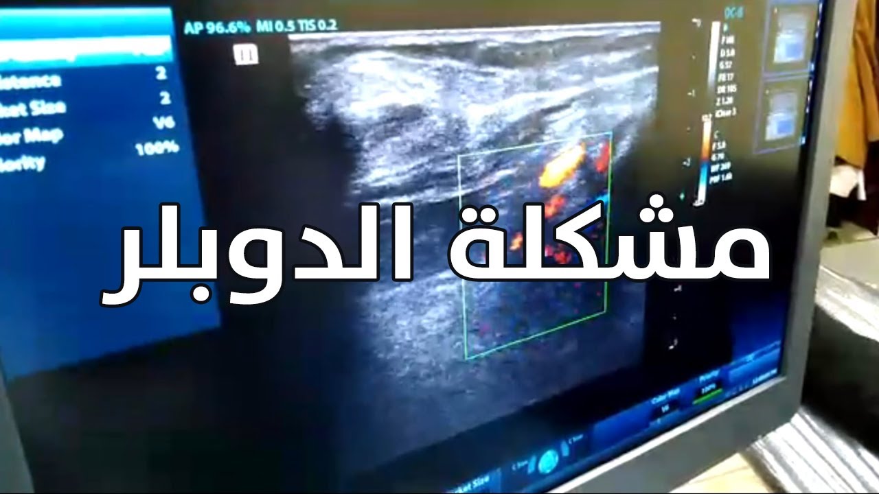 The Doppler problem and how to solve it?