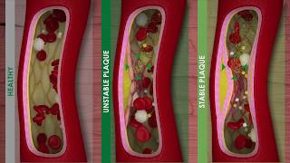 ATHEROSCLEROSIS and CARDIOVASCULAR DISEASE