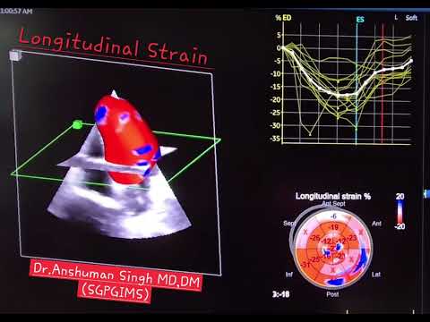 Longitudinal strain by echocardiography 