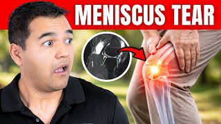 Do Bucket Handle Meniscus Tears Always Need Surgery?