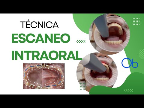 Técnica de Escaneo intraoral