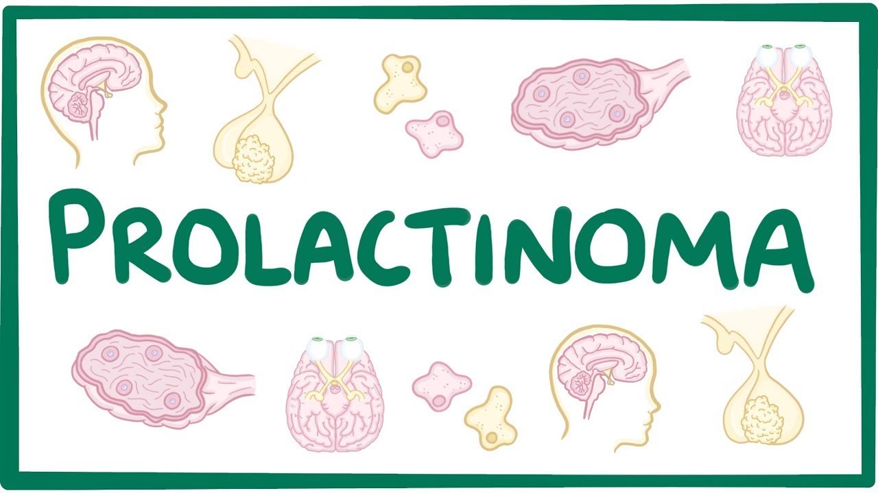 Prolactinoma - causes, symptoms, diagnosis, treatment, pathology