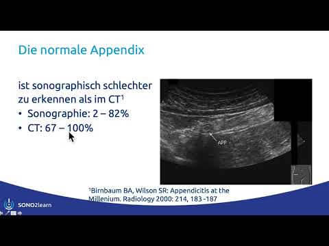 Fallbericht N° 43: ein Zufallsbefund im Sonographiekurs