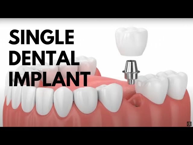Single Dental Implant Animated