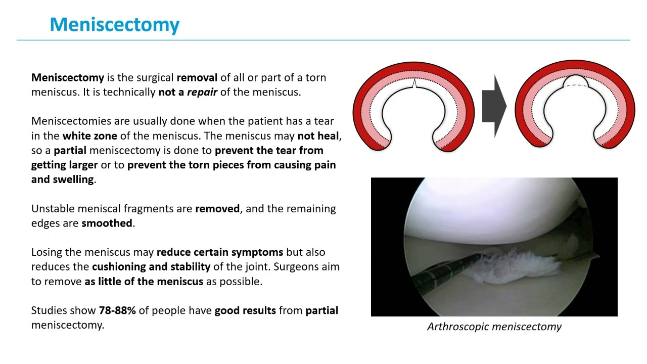 knee arthroscopy and meniscus procedure