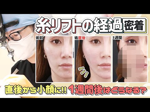 【小顔リフトアップ】糸リフトで頬こけ解消！腫れは？痛みは？ダウンタイムについて聞いてみた【大阪TAクリニック】