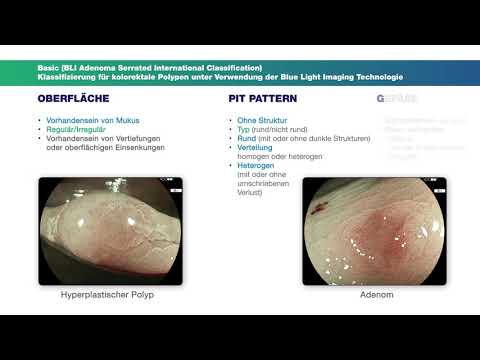 Basic-Klassifikation Kolonpolypen