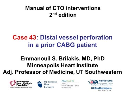 Case 43: Manual of CTO Interventions - Perforation in prior CABG patient