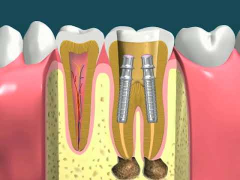 Dental Video of RCT Manual with 2 Posts and Crown - The Tooth