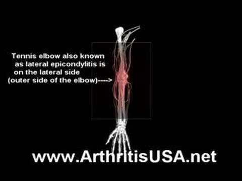 Golfer's elbow as discussed by Doctor Alimorad Farshchian