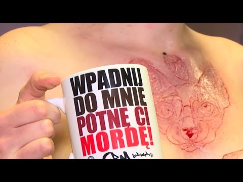 Jak robi się skaryfikacje?