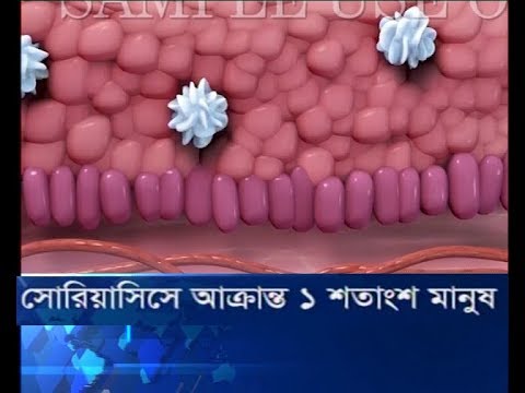 সোরিয়াসিতে আক্রান্ত ১ শতাংশ মানুষ