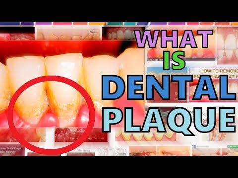 WHAT IS DENTAL PLAQUE? DENTAL PLAQUE MADE EASY - COMPOSITION - FORMATION - EFFECTS