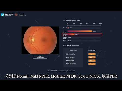 糖尿病眼部影像診斷輔助分析技術