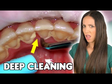 What To Expect At Your Deep Cleaning At The Dentist