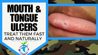 MOUTH & TONGUE Ulcers (Canker Sores) - How To Get Rid Of Them Naturally