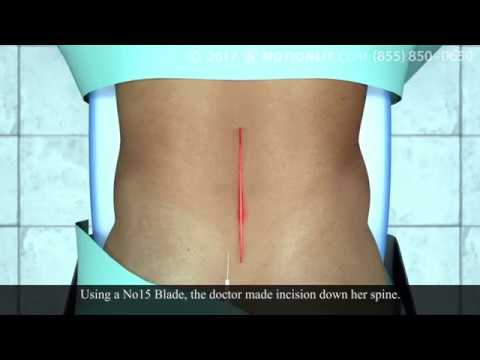Lumbar Surgery Animation | Spinal Cord Surgery Animation