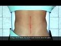 Lumbar Surgery Animation Spinal Cord Surgery Animation