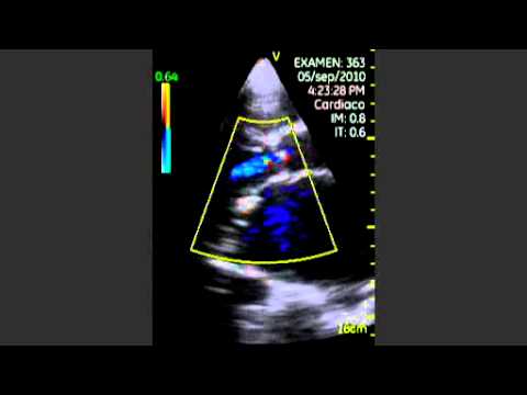 Aortic Insufficiency